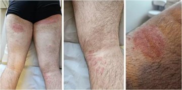 Brasil registra 1� caso de paciente infectado por fungo resistente