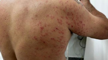 Morador de Ara�atuba � atacado por enxame de abelhas em Osvaldo Cruz