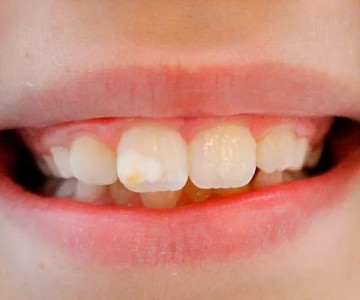 Anti-inflamatrios comuns na infncia podem causar alteraes nos dentes, mostra estudo