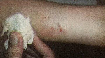 Menina de 9 anos  picada por escorpio dentro de escola em Adamantina