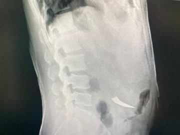 Homem  socorrido aps engolir uma faca em Cndido Mota