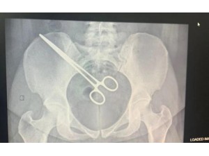 Instrumento cirrgico  esquecido em corpo de mulher aps cirurgia em Araatuba