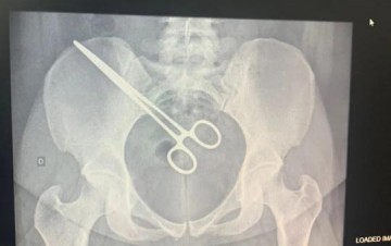 Instrumento cirrgico  esquecido em corpo de mulher aps cirurgia em Araatuba